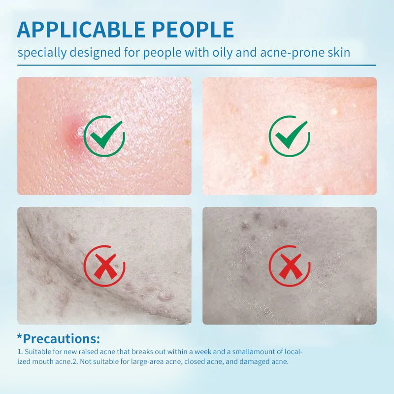 Acne-Care Essence