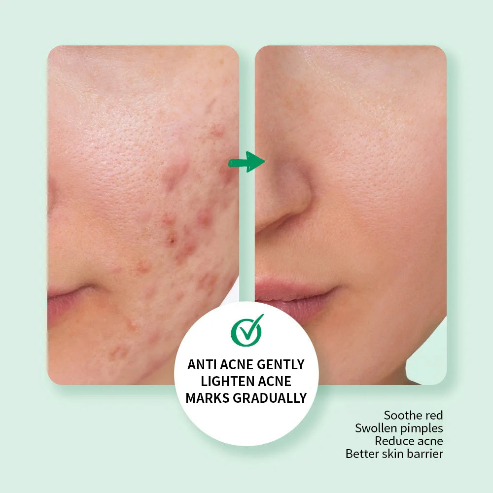 Tea Tree Anti Acne Gently Lighten Acne Mask